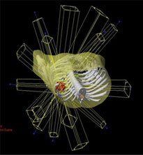 図3. ３次元形状でとらえたターゲット（標的）へ高精度に効果的な線量を照射する（治療計画写真）