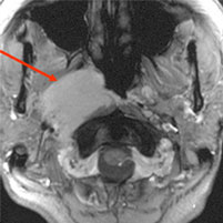 図4. 上咽頭癌放射線治療前の写真　矢印の白くべたっとした部分が病気の場所です。