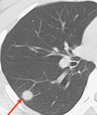 図7. 肺癌の放射線治療前のCT画像です。矢印の個所に円形の病気がみえます。