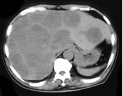 図1：大腸がん・肝転移治療前のCT写真